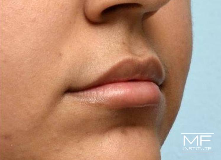Lip Contouring - Height - After