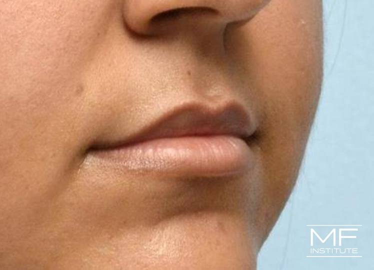 Lip Contouring - Height - Before