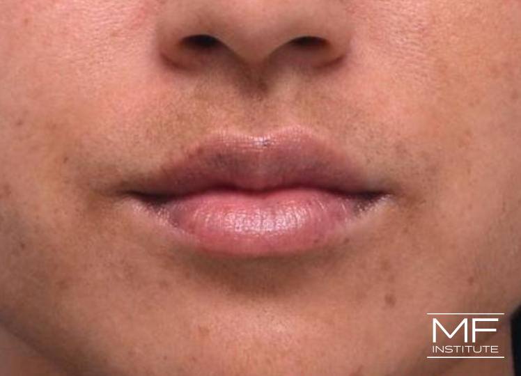 Lip Contouring - Fullness - After