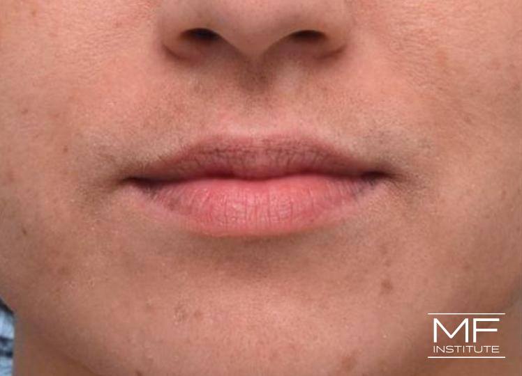 Lip Contouring - Fullness - Before