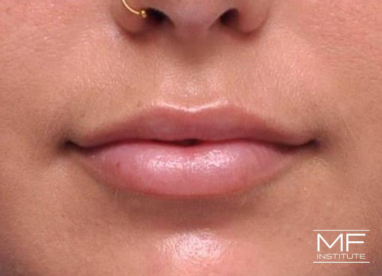 Lip Contouring - Proportion - After