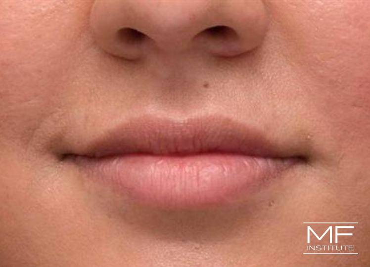 Lip Contouring - Widening - After