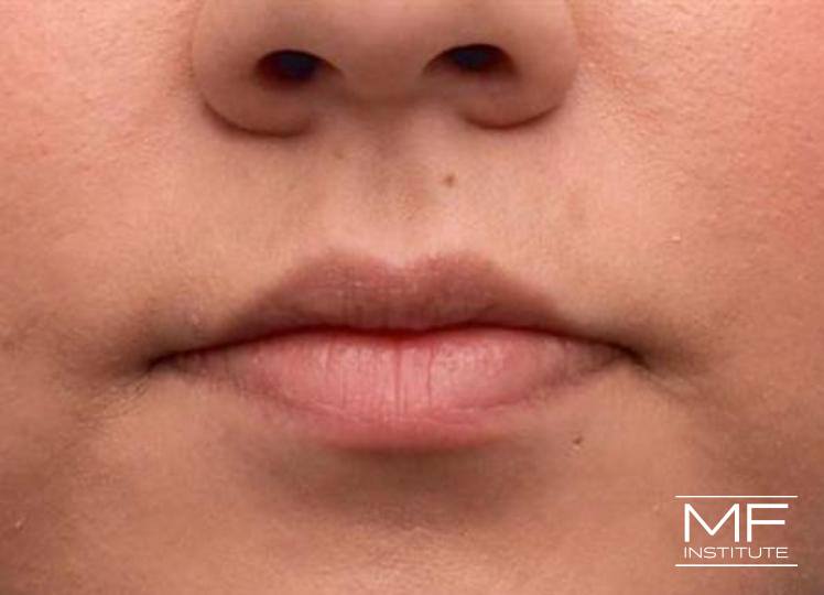 Lip Contouring - Widening - Before