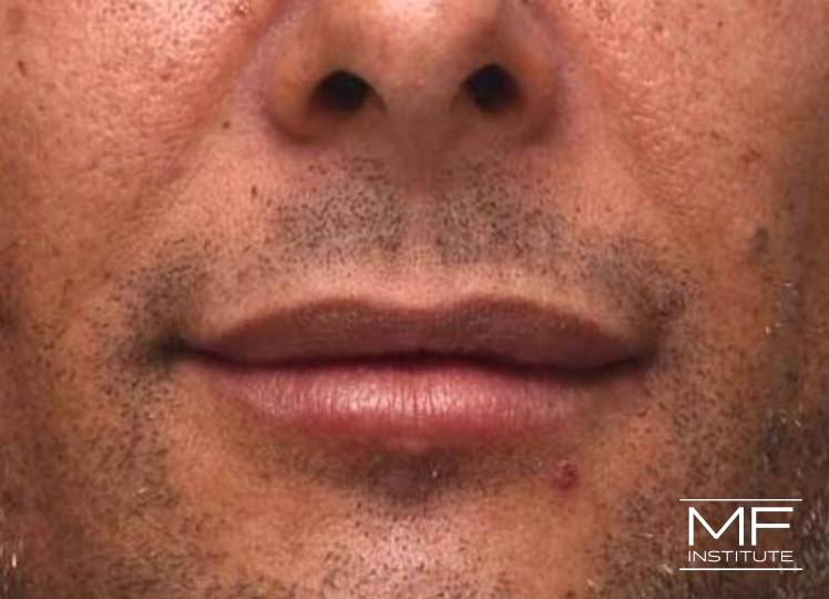 Lip Contouring - Male Lips - After