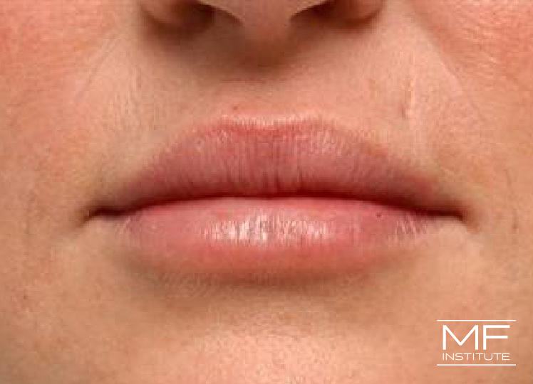 Lip Contouring - Asymmetry - After