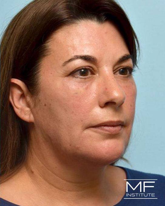 Lower Face Rejuvenation Problem Area - Jowls - After