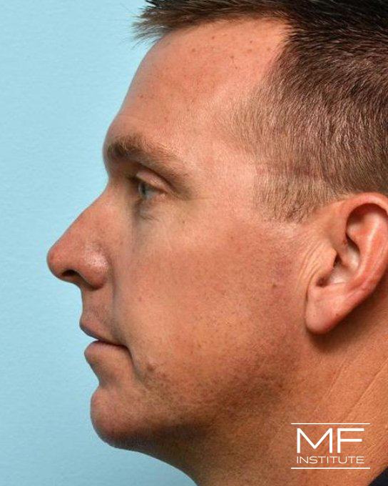 Lower Face Rejuvenation Problem Area - Jowls - After