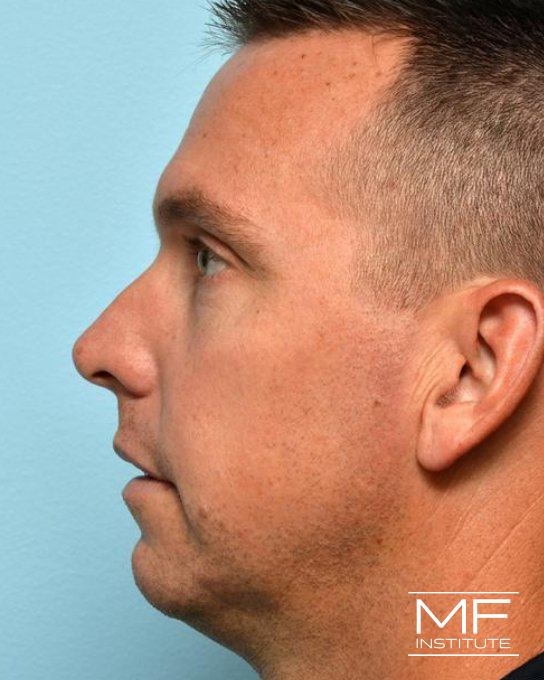 Lower Face Rejuvenation Problem Area - Jowls - Before
