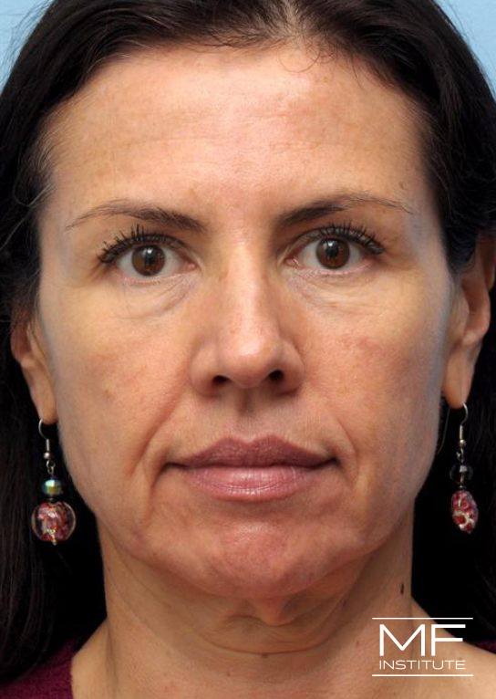 Lower Face Rejuvenation Problem Area - Marionette Lines - Before