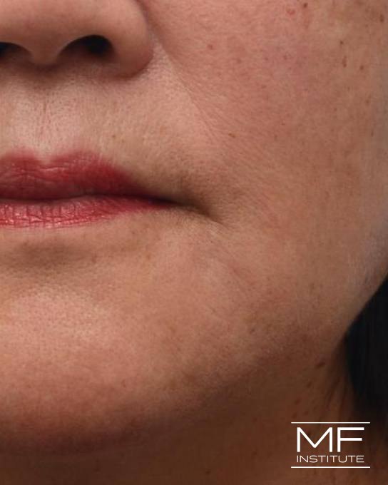 Lower Face Rejuvenation Problem Area - Marionette Lines - After