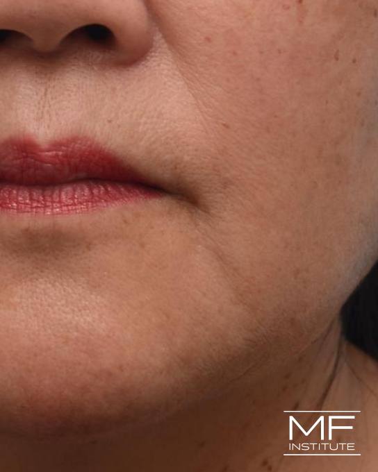 Lower Face Rejuvenation Problem Area - Marionette Lines - Before