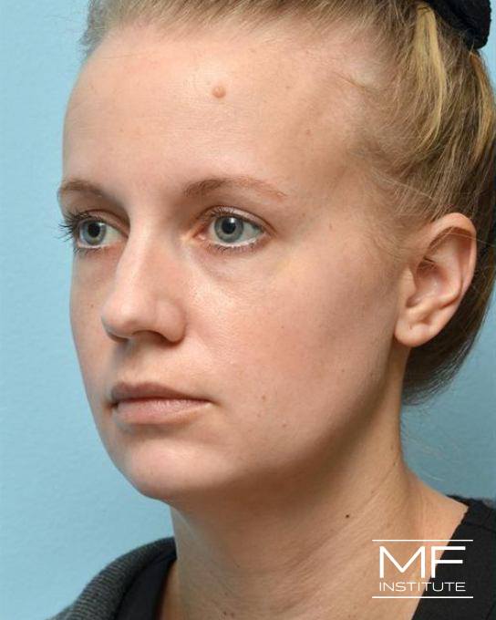The MFI Lift - Young Adult - Before