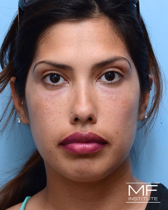 After under-eye treatment with dermal fillers.