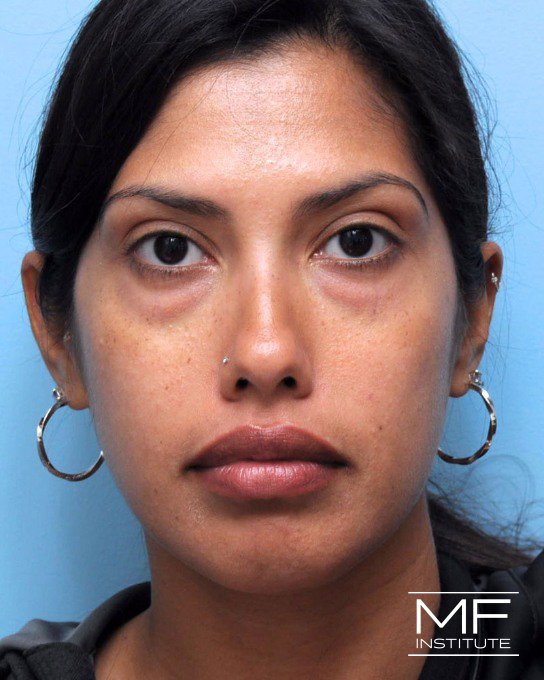 Before under-eye treatment with dermal fillers.