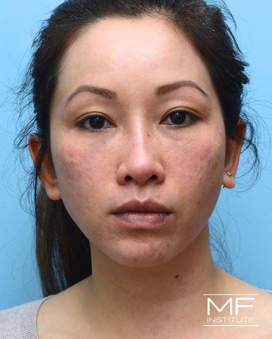 After nasolabial folds treatment with dermal fillers.