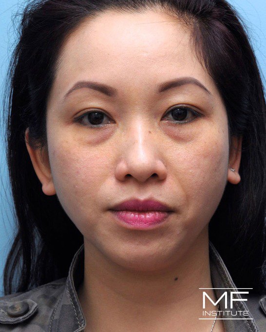 Before nasolabial folds treatment with dermal fillers.