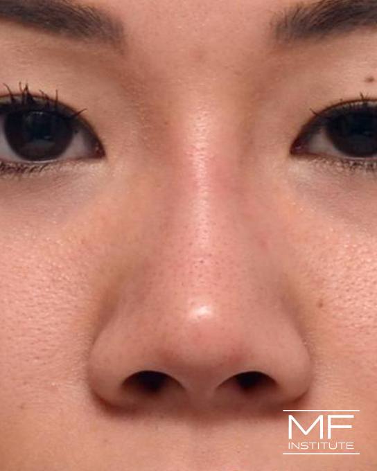 Nonsurgical Rhinoplasty - Augmenting the Bridge - After