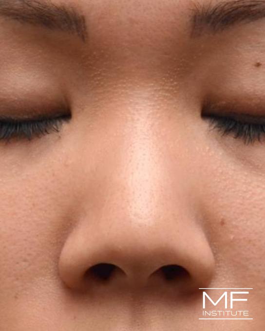 Nonsurgical Rhinoplasty - Augmenting the Bridge - Before