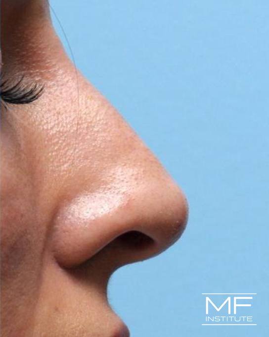 Nonsurgical Rhinoplasty - Reducing a Bump on the Bridge - After