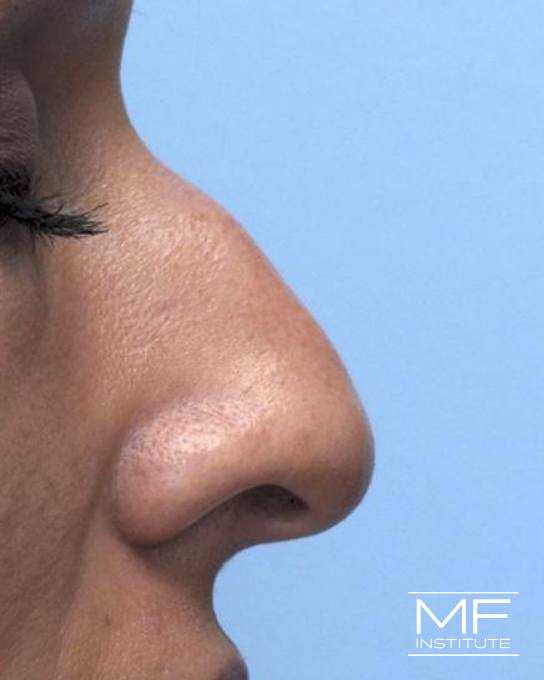 Nonsurgical Rhinoplasty - Reducing a Bump on the Bridge - Before