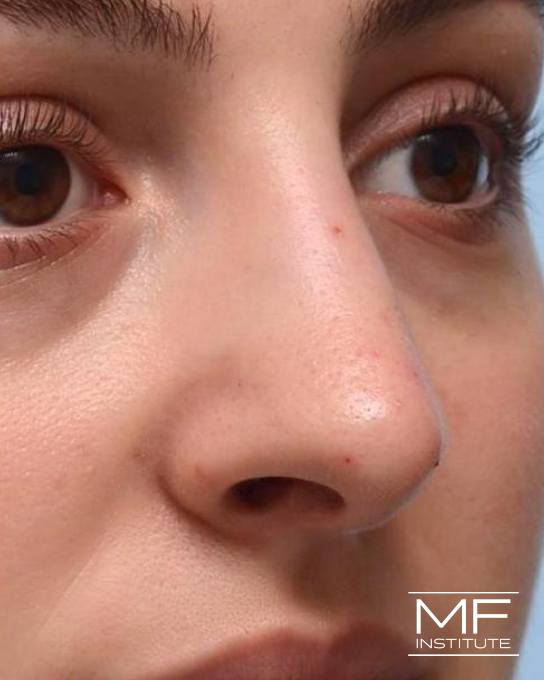 Nonsurgical Rhinoplasty - Correcting Deviations, Fractures & Concavities - After