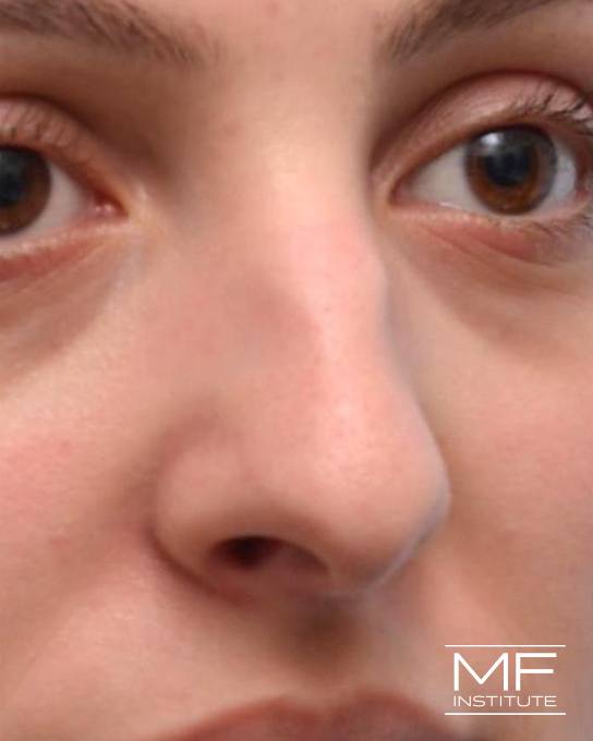 Nonsurgical Rhinoplasty - Correcting Deviations, Fractures & Concavities - Before