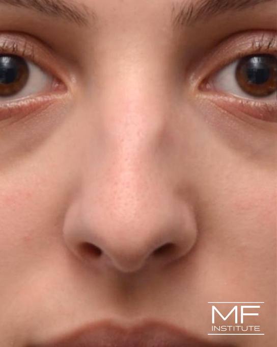 Nonsurgical Rhinoplasty - Correcting Deviations, Fractures & Concavities - Before