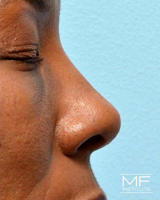 Nonsurgical Rhinoplasty - Defining the Nasal Tip - After