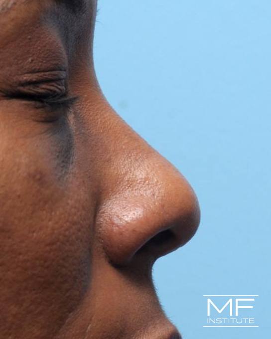 Nonsurgical Rhinoplasty - Defining the Nasal Tip - Before