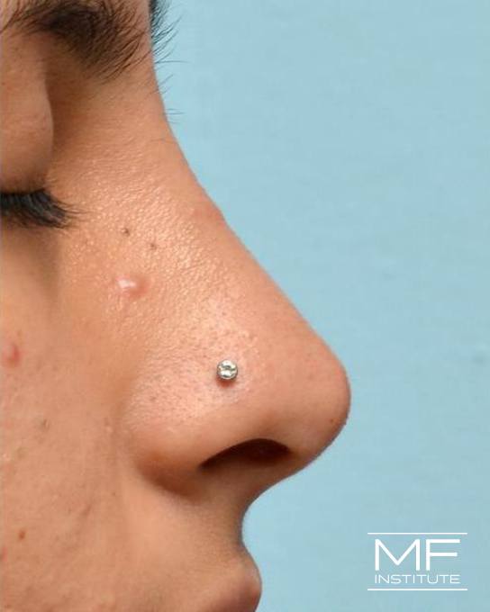Nonsurgical Rhinoplasty - Rotating a Droopy Tip - After