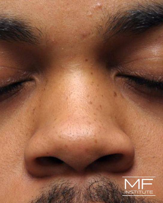 Nonsurgical Rhinoplasty - Narrowing the Bridge - Before