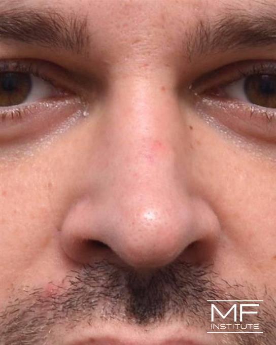 Nonsurgical Rhinoplasty - Straightening the Bridge - Before