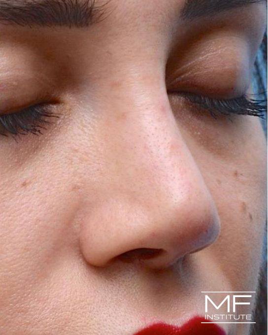 Nonsurgical Rhinoplasty - Post Surgical - After