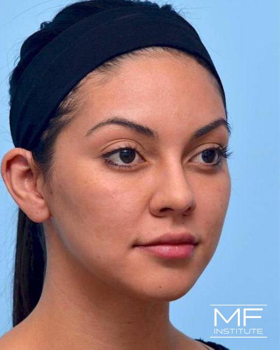 Upper Face Contouring Problem - Brow Position & Shape - After