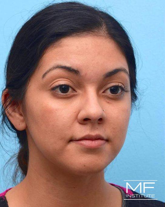 Upper Face Contouring Problem - Brow Position & Shape - Before