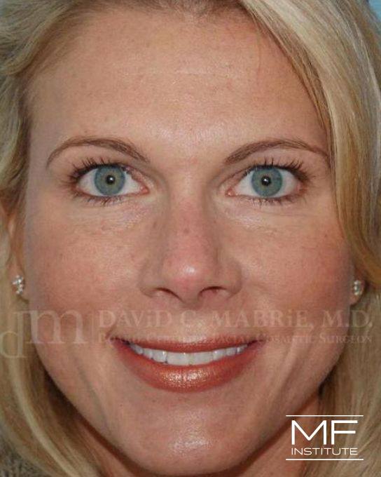 Upper Face Contouring Problem - Eye Shape & Size - After