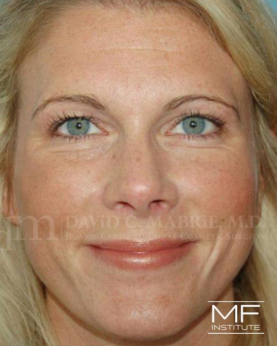 Upper Face Contouring Problem - Eye Shape & Size - Before