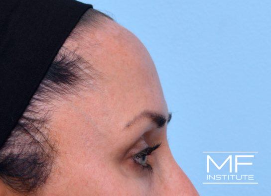 Upper Face Contouring - Forehead Contour Enhancer - After