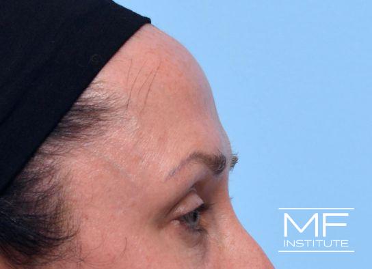 Upper Face Contouring - Forehead Contour Enhancer - Before