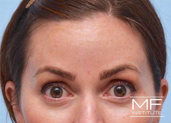 Upper Face Contouring Problem - Horizontal Forehead Wrinkles - After