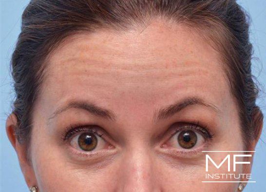 Upper Face Contouring Problem - Horizontal Forehead Wrinkles - Before