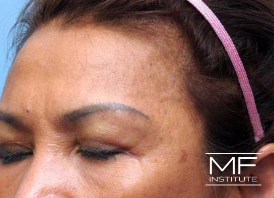 Upper Face Contouring - Temple Contour Enhancer - After