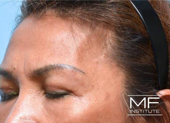 Upper Face Contouring - Temple Contour Enhancer - Before