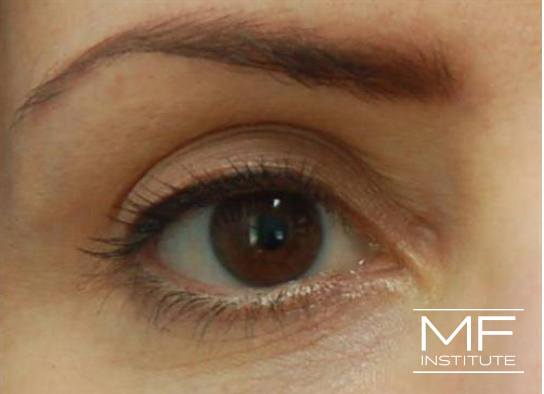 Upper Face Contouring - Upper Eyelids Enhancer - After
