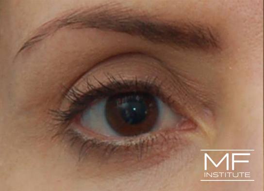 Upper Face Contouring - Upper Eyelids Enhancer - Before