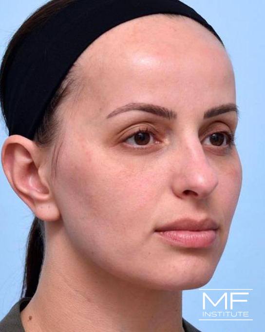 Upper Face Rejuvenation Problem Area - Low Eyebrows - After