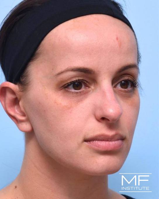 Upper Face Rejuvenation Problem Area - Low Eyebrows - Before