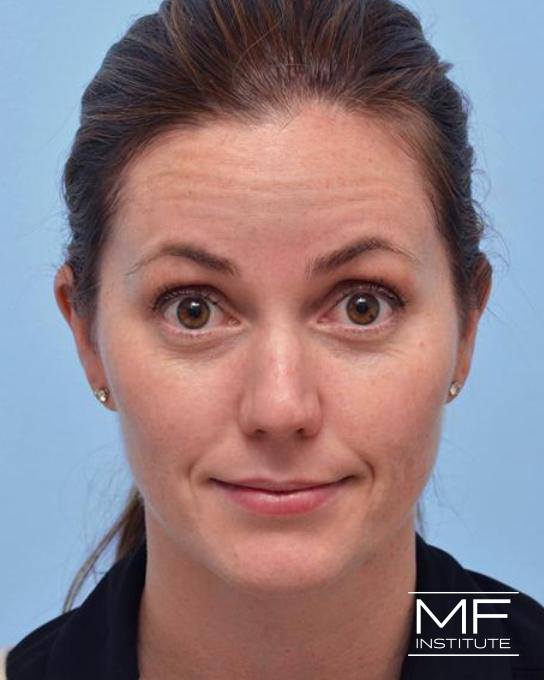 Upper Face Rejuvenation Problem Area - Forehead Wrinkles - Before
