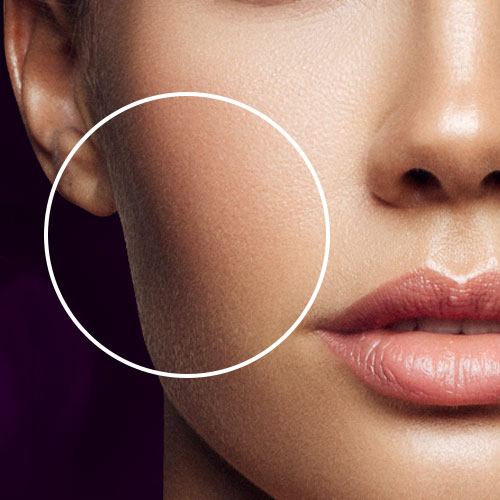 Focus on full cheeks and lips to create youthfulness with dermal fillers in San Francisco
