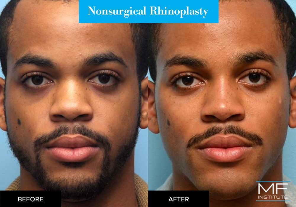Nonsurgical rhinoplasty before and after case from Mabrie Facial Institute in San Francisco (case #300)